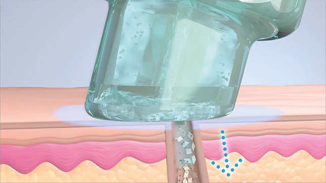GlySal™-Säurepeeling